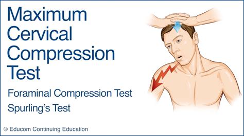 compression test chiropractic|Maximum Cervical Compression Test (Spurling’s Test) .